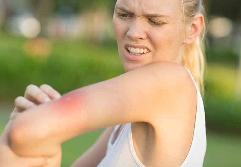 Picture of a blond lady with a wasp sting on her arm